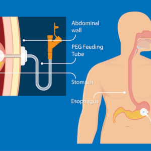 PEG feeding tube